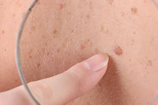 أسباب سرطان الجلد وطرق الوقاية منه