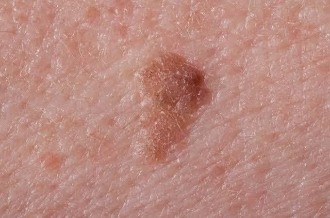 أخطر أنواع سرطان الجلد تعرف علي الأسباب وأهم الأعراض وطرق العلاج