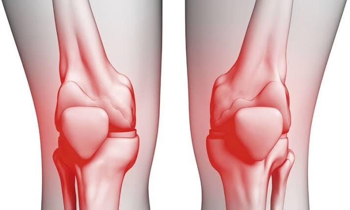 أعراض خشونة الركبة وكيف يتم تشخيص الحالة المصابة وطرق علاجها