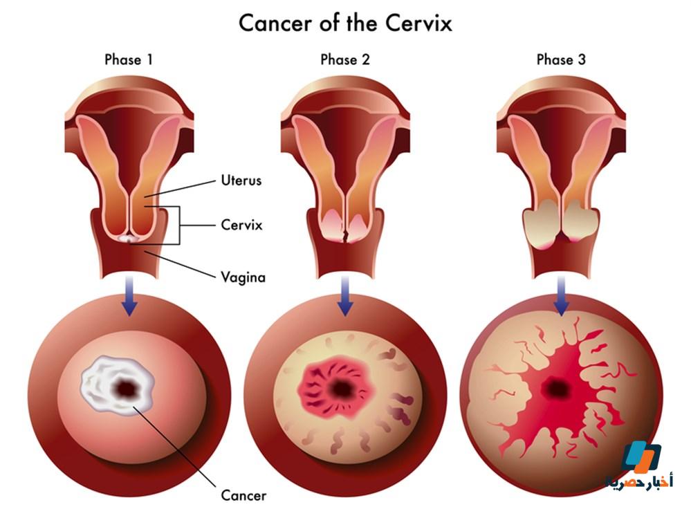 أعراض سرطان الرحم وأبرز التفاصيل الهامة مثل الأسباب والتشخيص والعلاج