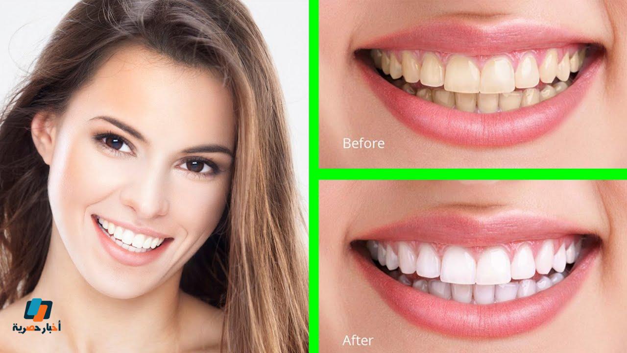 إزالة أصفرار الأسنان بمنتجات طبيعية