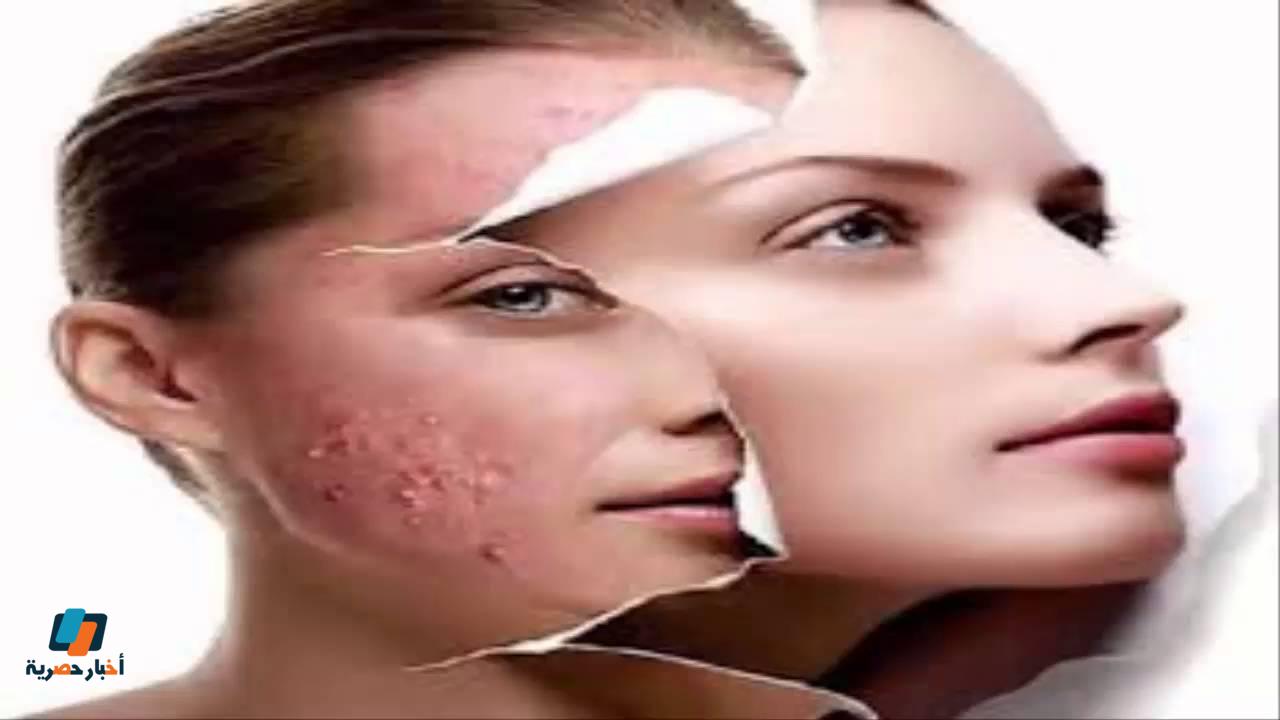 علاج حبوب الوجه ومشاكل البشرة بمكونات طبيعية ومفيدة مجربة 100%