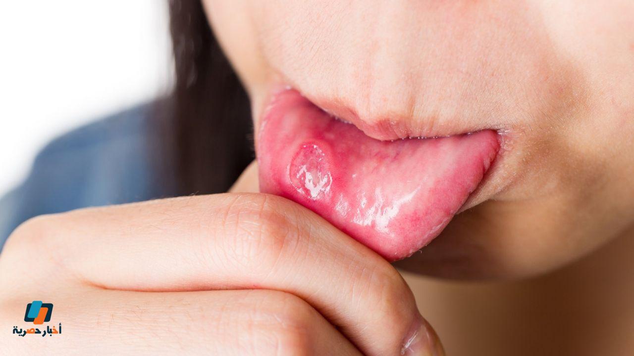 هل فطريات الفم خطيرة